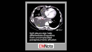 Split Pleura Sign radiology doctor medical [upl. by Anitnatsnok]