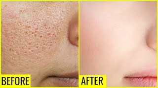 How to Get Rid of Large OPEN PORES Permanently  Anaysa [upl. by Swane]