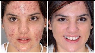 Máscara para eliminar acne e rosácea  TRATAMENTO CASEIRO [upl. by Eicart762]