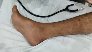 Bilateral Hyperreflexia and Ankle Clonus [upl. by Yarw]