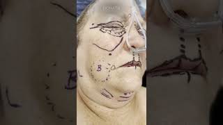 Facelift Blepharoplasty and Fat Transfer  Before surgery vs immediately after [upl. by Nilhtac995]