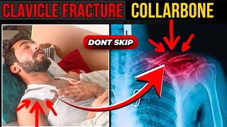 i broke my clavicle  collarbone fracture  clavicle fracture treatment without surgery [upl. by Daphene]