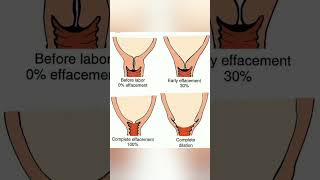 Before and after labor 🤰 dilatation of cervix knowledge easylearning medico shortsvideo share [upl. by Dmitri]