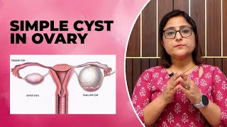 simple ovarian cyst ओवरी में सिस्ट  क्या करें [upl. by Nosemyaj]