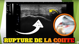 Echographie dune rupture de la coiffe des rotateurs [upl. by Reffineg]