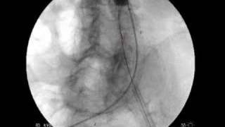 Endovascular Aneurysm Repair For AAA [upl. by Eiliab261]