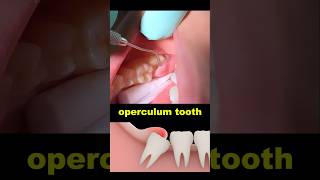 Operculum tooth treatment dentist dentistry wisdomtooth [upl. by Ainej]