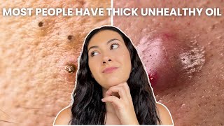 How To Treat Every Type of Acne Comedones Nodules Cysts [upl. by Lamee]