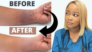 How to Treat ECZEMA  Black Brown skin  Dry Skincare Routine The 1 Best Remedy for Eczema [upl. by Audrey]