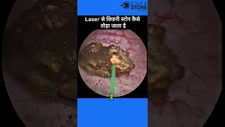 23 mm Kidney Stone treatment  RIRS  Retrograde intrarenal surgery shorts [upl. by Perdita]