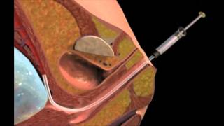 Chorionic Villus Sampling [upl. by Taft]