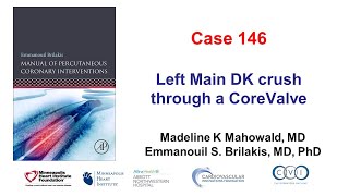 Case 146 PCI Manual  DK crush through a CoreValve [upl. by Damalas]