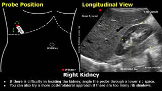 Kidney Ultrasound Probe Positioning  Transducer Placement amp Scanning  Abdominal USG  Sonography [upl. by Drof]