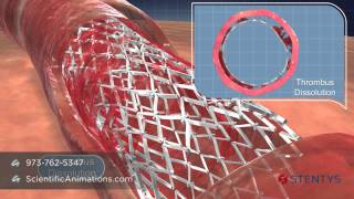 3D Medical Animation of Coronary Stent Procedure [upl. by Nethsa]