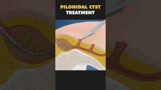 PILONIDAL CYST TREATMENT [upl. by Chuu305]