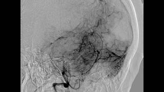 Diagnostic Cerebral Angiography and technique of vertebral artery catheterization [upl. by Xel476]