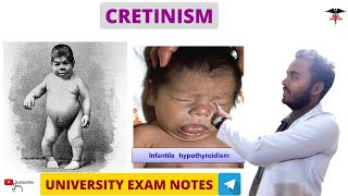 Cretinism  Hypothyroidism  Endocrine Physiology [upl. by Umont]