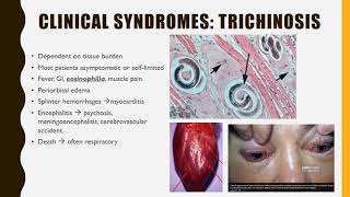 Trichinella SPIRALIS [upl. by Tiffa]