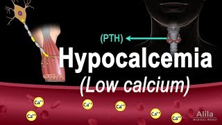 Hypocalcemia Low Calcium Pathology Causes Symptoms and Treatment Animation [upl. by Lennej195]