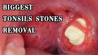 biggest tonsils stones removal tonsilolith hidden huge tonsils stones removal [upl. by Fretwell]