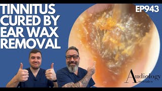 TINNITUS CURED BY EAR WAX REMOVAL  EP943 [upl. by Brookner758]