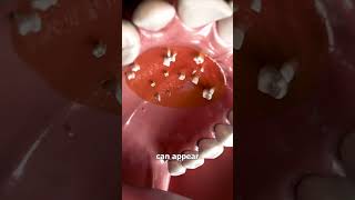 Hyperdontia Extra Teeth in the Roof of Your Mouth Learn About This Condition   Cosmodent India [upl. by Given942]