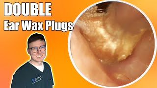 “Unbelievable difference”  Hearing TRANSFORMED after removing two plugs  Ear Wax Removal Ep 10 [upl. by Marie-Jeanne579]