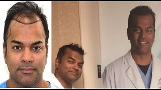 LIVE VIDEO of Hair Transplant in India at Medispa by Dr Suneet Soni Jaipur amp Delhi [upl. by Begga]