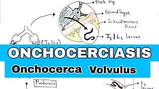 onchocerciasis  River blindness  Life cycle symptoms and treatment  Bio science [upl. by Ramo485]