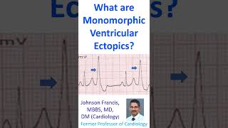 What are monomorphic ventricular ectopics [upl. by Tenenbaum]