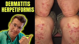 Dermatitis Herpetiformis rash seen in Coeliac Disease aka gluten intolerance explained [upl. by Homere]