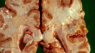 Cerebral Ischaemia and Infarction  Pathology mini tutorial [upl. by Martha]