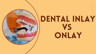 Dental Inlay vs Onlay What are their differences [upl. by Alyekahs]