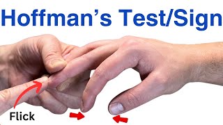 How to Perform a Hoffmans Test  Inverted Supinator Sign  Clonus  Hyperreflexia [upl. by Fesuy]