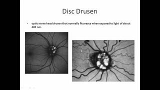 Fluorescein Angiography [upl. by Sasnett]