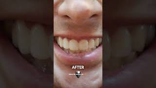 The BEST Accessories for Your Smile  Snap On Veneers [upl. by Quartet]