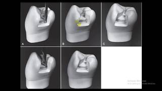 Class II amalgam restoration  Lec 5 [upl. by Kciredohr40]