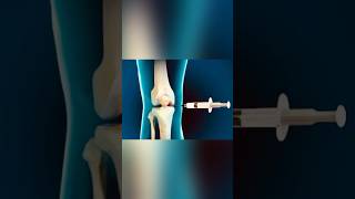 KNEE JOINT INJECTION  intraarticular injectionomkarclinic12369 [upl. by Annahvas726]