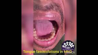 TONGUE FASCICULATIONS [upl. by Dugas875]