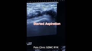 Knee joint ultrasound Guided effusion Aspiration [upl. by Lapham246]