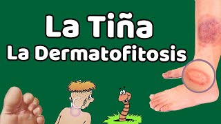 LA DERMATOFITOSIS Causas signos y síntomas diagnóstico y tratamiento [upl. by Idhem689]