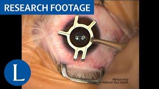 Surgical video Femtosecond LASIK procedure Video 1 of 2 [upl. by Yarw]