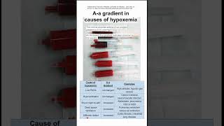 Aa gradient hypoxemia [upl. by Geraud52]