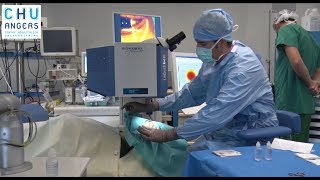 La chirurgie au laser en ophtalmologie du CHU Angers [upl. by Lachance]