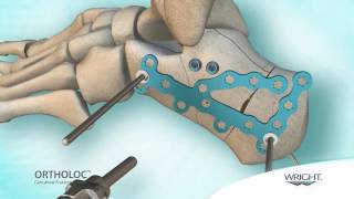 Wright  Ortholoc Calcaneal Fracture system [upl. by Leaffar]