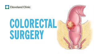 Colorectal Surgery  Cleveland Clinic [upl. by Arhat]