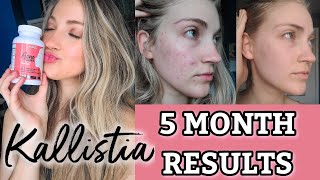 Kallistia Acne Cleanse Review  5 Month Results [upl. by Ssitruc]