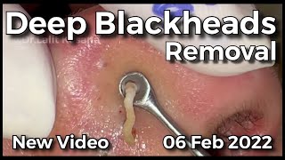 Deep Blackhead Removal by drkasanas [upl. by Eanat294]