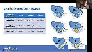 Tout sur la radiothérapie [upl. by Pennington]