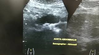 USG Aorta Abdominalis  kasus apa [upl. by Ylrad]